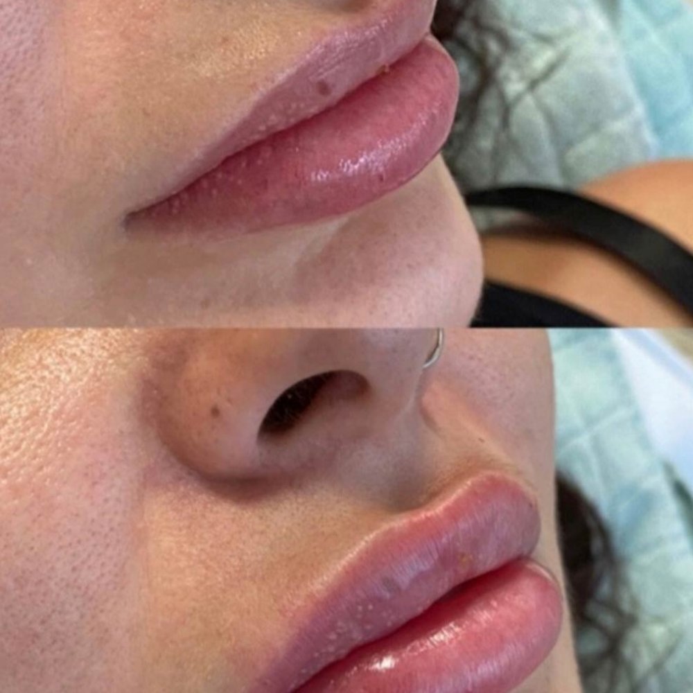 lip augmentation before/after photo