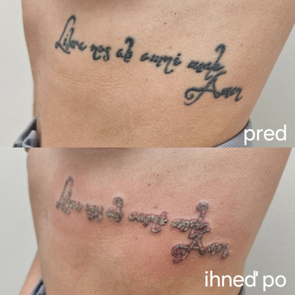 removal of tattoo before/after