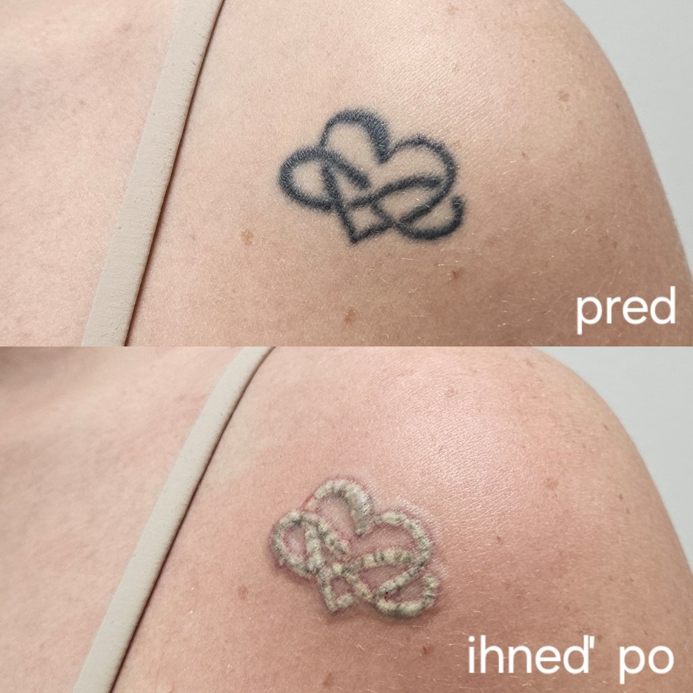 tatoo removal before and after photo