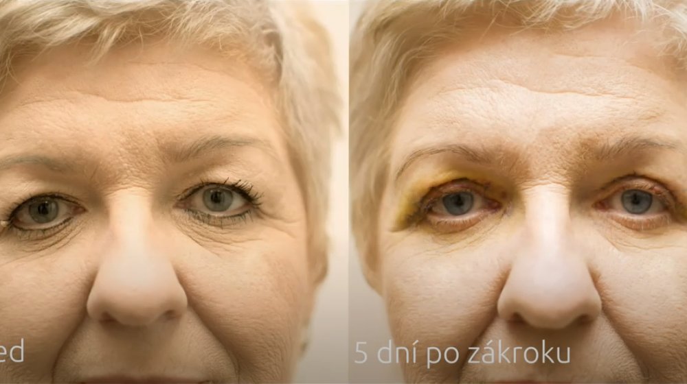 Šťastná výherkyňa Gabriela - Blefaroplastika